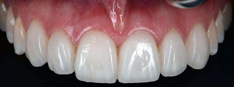 perfectly designed ceramic crowns