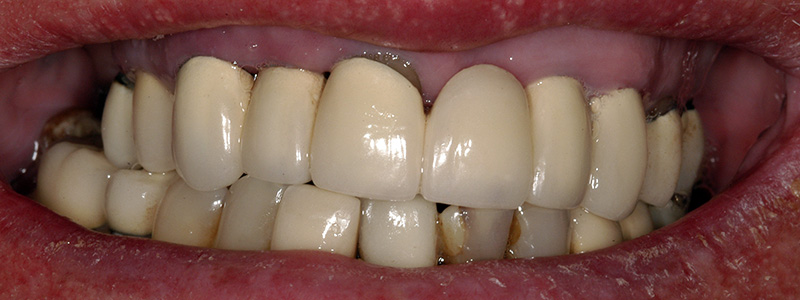 poorly designed ceramic crowns